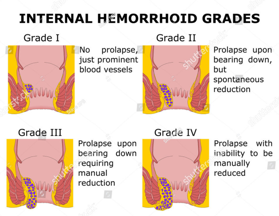 piles-treatment-in-bangalore-piles-clinic