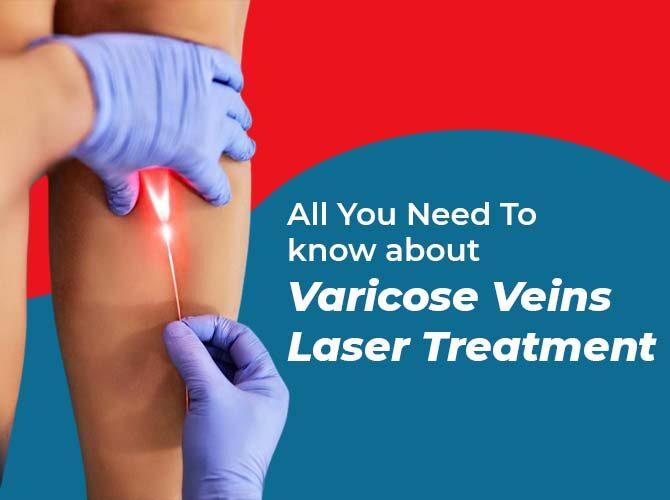 Varicose Veins Laser Treatment