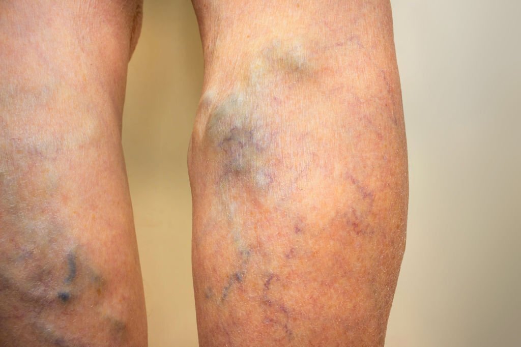 varicose vein blood clot