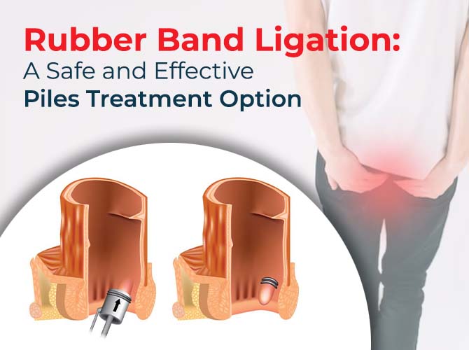 Rubber Band Ligation: A Safe and Effective Piles Treatment Option