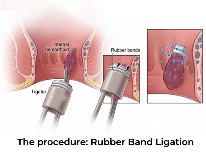 Rubber Band Ligation: A Safe and Effective Piles Treatment Option