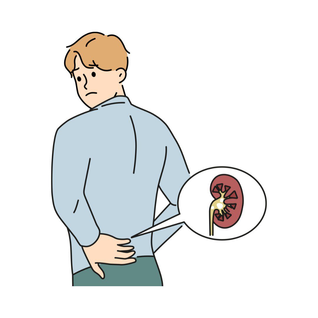 Kidney stones