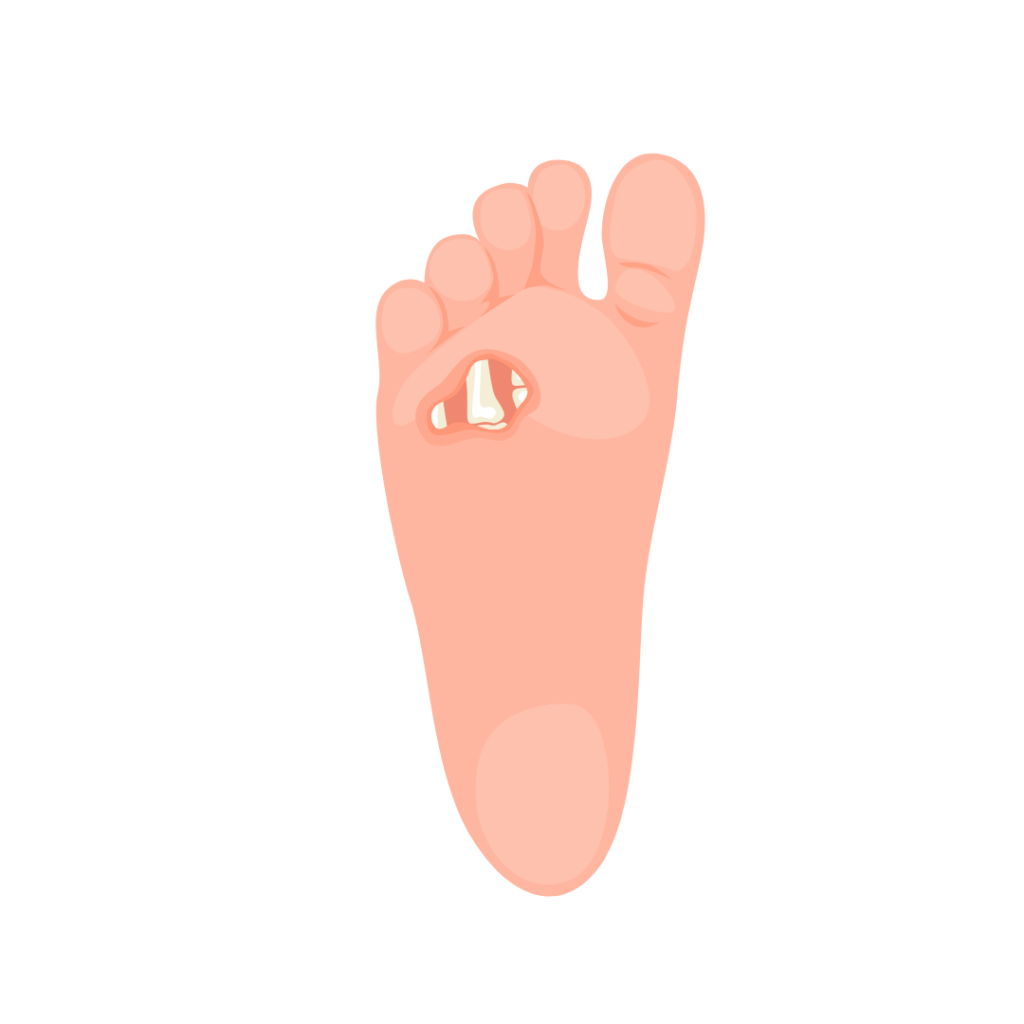 Diabetic foot ulcer