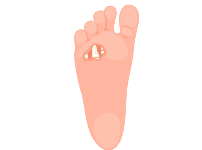 Diabetic foot