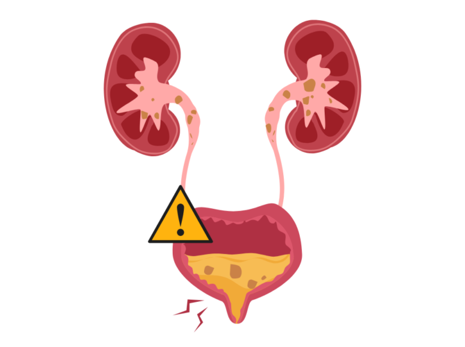 Gall Bladder Stones