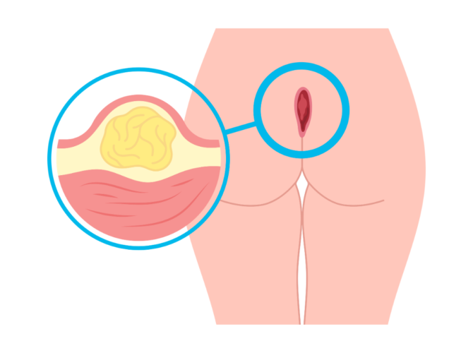 Pilonidal sinus