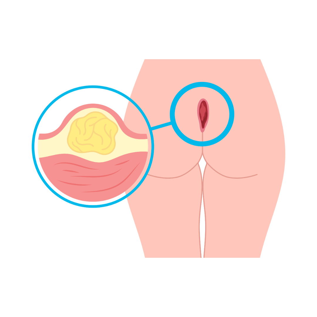Pilonidal sinus treatment