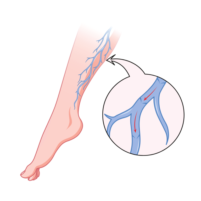 Varicose Veins Treatment