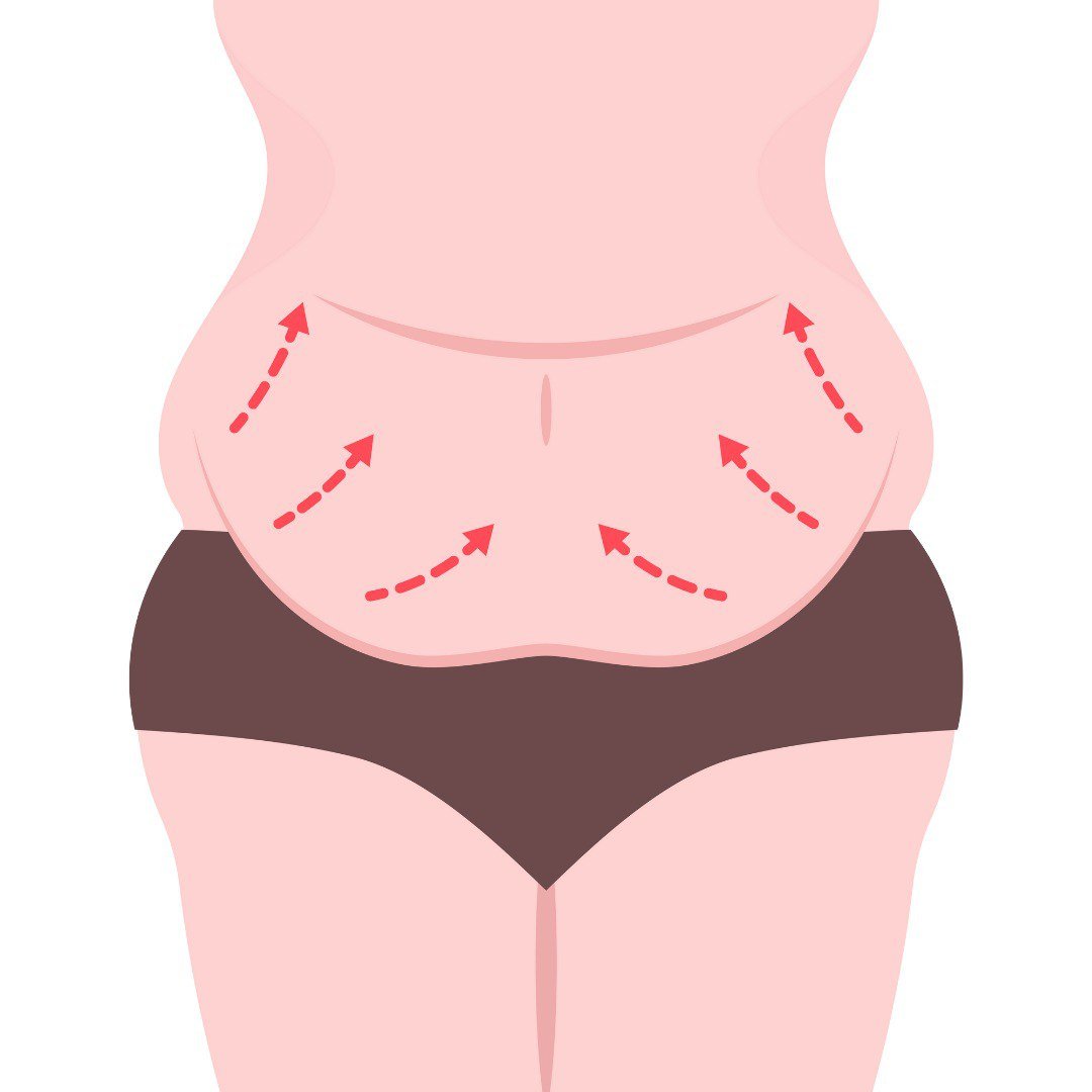 liposuction in bangalore