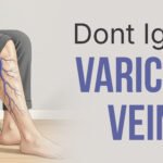 Varicose Veins Laser Treatment
